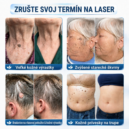 👩‍⚕️💯 Oficiálny obchod | MURWON® 🌥️ Mikroihličková náplasť na odstránenie kožných nedokonalostí (Na kožné výrastky, drobné kožné útvary, bradavice, materské znamienka, starecké škvrny a pigmentové nerovnosti.)💛