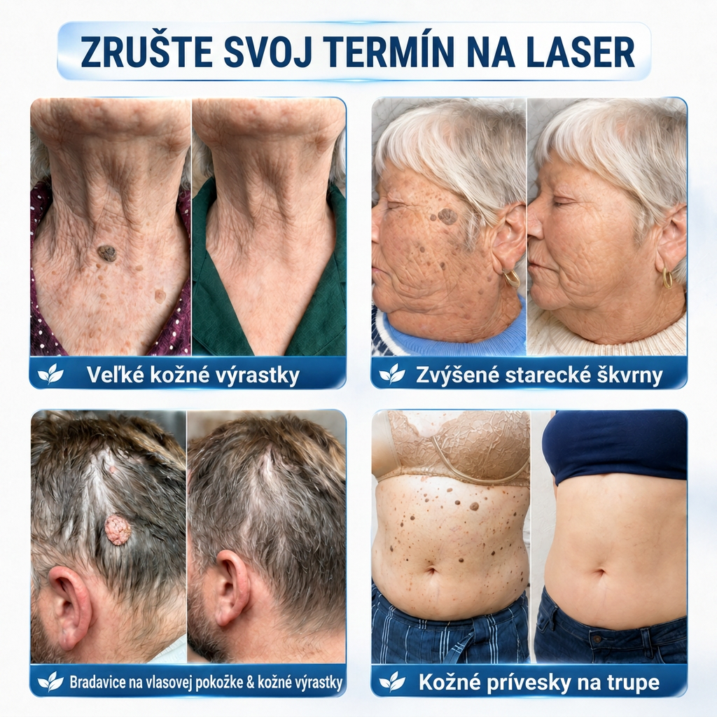 👩‍⚕️💯 Oficiálny obchod | MURWON® 🌥️ Mikroihličková náplasť na odstránenie kožných nedokonalostí (Na kožné výrastky, drobné kožné útvary, bradavice, materské znamienka, starecké škvrny a pigmentové nerovnosti.)💟