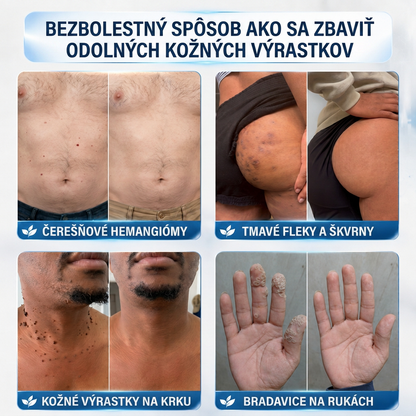 👩‍⚕️💯 Oficiálny obchod | MURWON® 🌥️ Mikroihličková náplasť na odstránenie kožných nedokonalostí (Na kožné výrastky, drobné kožné útvary, bradavice, materské znamienka, starecké škvrny a pigmentové nerovnosti.)💛