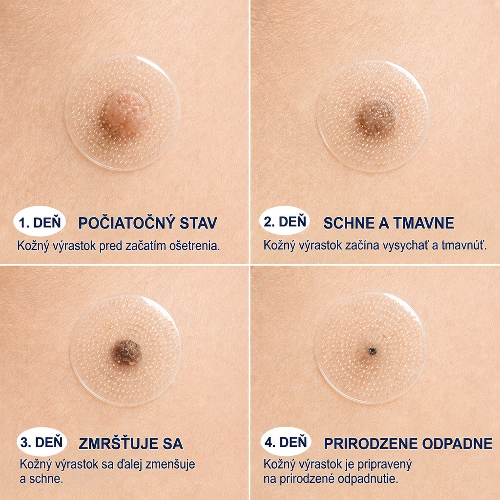 👩‍⚕️💯 Oficiálny obchod | MURWON® 🌥️ Mikroihličková náplasť na odstránenie kožných nedokonalostí (Na kožné výrastky, drobné kožné útvary, bradavice, materské znamienka, starecké škvrny a pigmentové nerovnosti.)💛