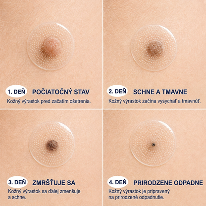 👩‍⚕️💯 Oficiálny obchod | MURWON® 🌥️ Mikroihličková náplasť na odstránenie kožných nedokonalostí (Na kožné výrastky, drobné kožné útvary, bradavice, materské znamienka, starecké škvrny a pigmentové nerovnosti.)💛